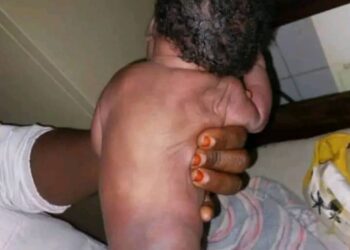 Guinée : Naissance d’un bébé avec malformation rare à Faaranah